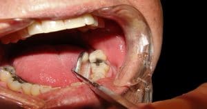 Retração gengival causa perda dos dentes e outras doenças