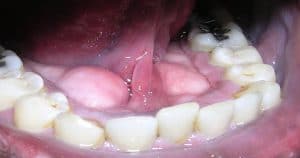 Torus mandibular normalmente é retirado em cirurgias pré-protéticas