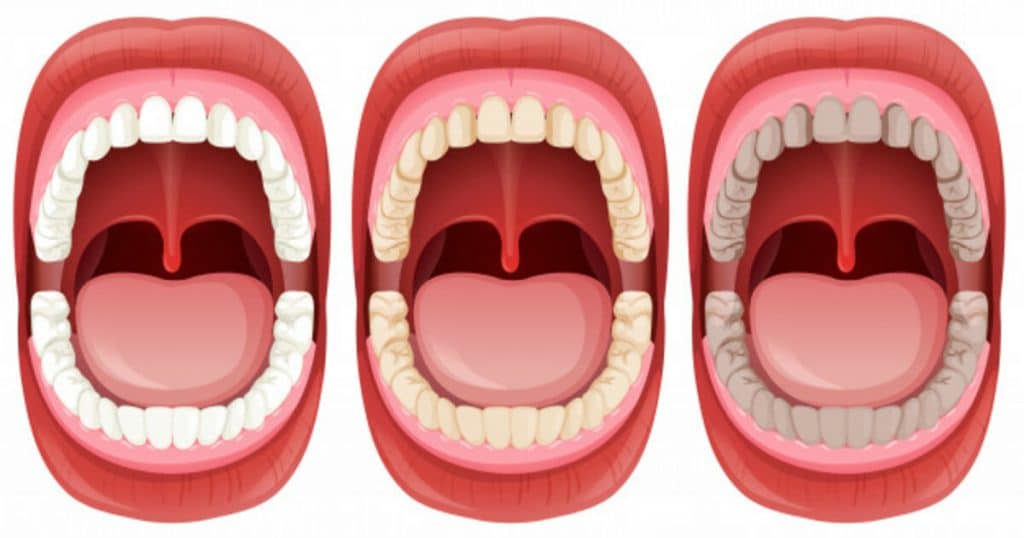Tudo Sobre o Dente Canino, sua Função e Problemas Tudo Sobre o Dente Canino, sua Função e Problemas
