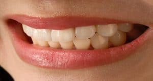 Imagem focalizada num sorriso mostrando os dentes - Quem tem prótese dentária pode fazer clareamento dental? Descubra!