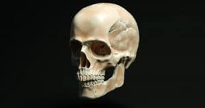 Crânio humano - Entenda o que é osteoplastia e como ela funciona