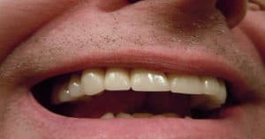 Recuperar esmalte do dente exige tratamento profissional