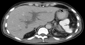 Imagem de uma ressonância magnética do cérebro - Entenda tudo sobre a trombose do seio cavernoso