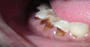 Dentes da arcada dentária inferior apresentando uma alta concentração de placa bacteriana endurecida com coloração amarronzada. A placa está concentrada perto das gengivas.
